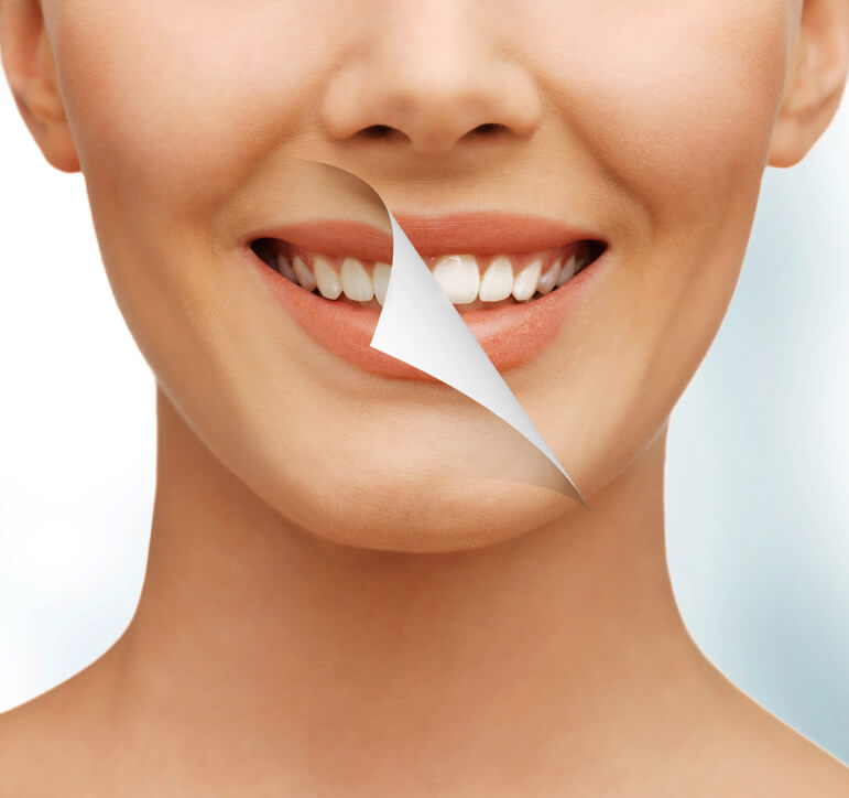 Take Home Teeth Whitening - Services we offer